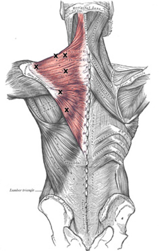 Alaskan Wasilla Palmer Mat-Su Acupuncture Massage Trigger points