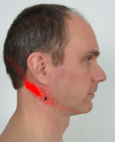 Digastric posterior portion trigger point referral patten