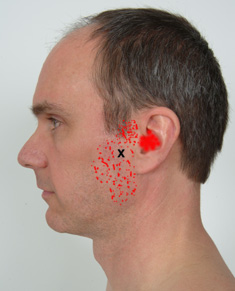 Masseter trigger points #4