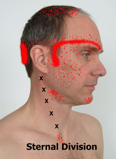 Sternocleidcomastoid sternal trigger points