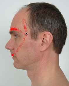 Temporalis trigger points #1