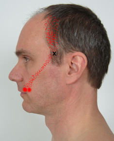 Temporalis trigger points #2