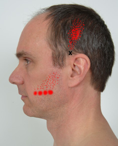 Temporalis trigger points #4