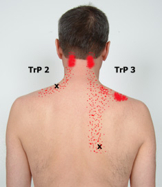 Trapezius referral patterns #2 & 3